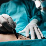 Liposuction Nedir, Nasıl Yapılır? Liposakşın Tedavisi Hangi Durumlarda Uygulanır?
