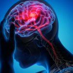 Nöroloji uzmanından inmeye karşı uyarı: “Erken müdahale felci önler”